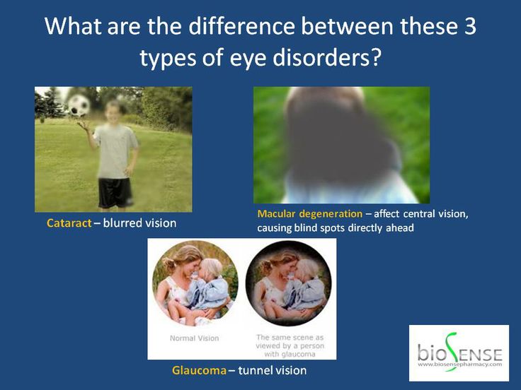 Eye Diseases Macular Degeneration, Cataract and Biosense