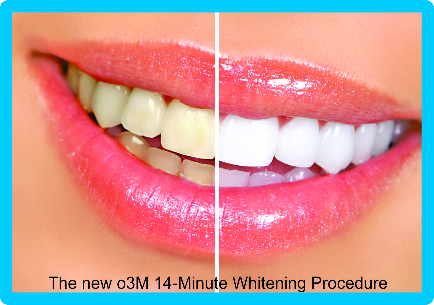 Major Cosmetic Teeth Whitening Breakthrough at DaVinci 